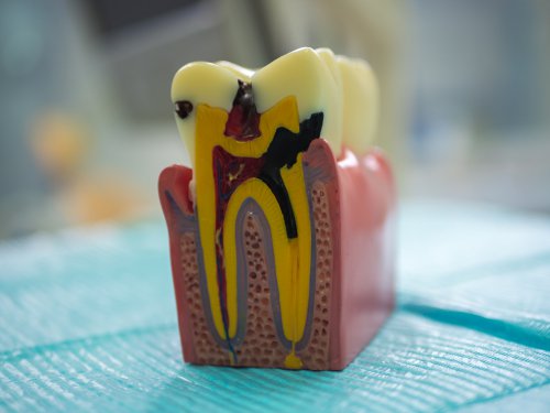 Лікування пульпіту ID:995